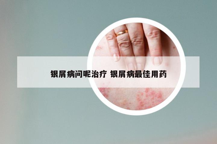 银屑病问呢治疗 银屑病最佳用药
