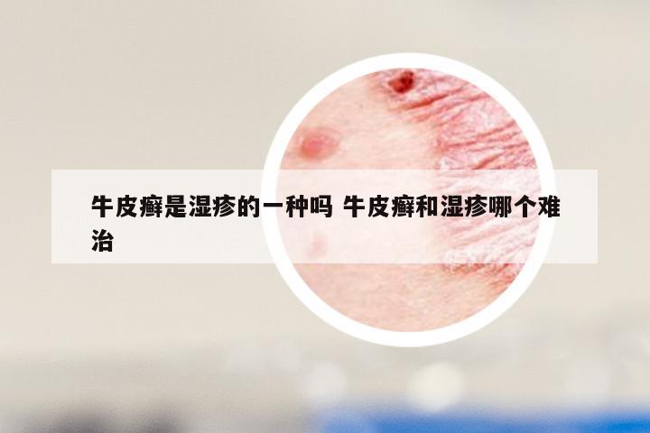 牛皮癣是湿疹的一种吗 牛皮癣和湿疹哪个难治