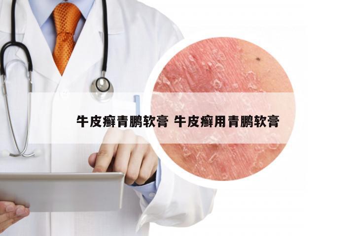 牛皮癣青鹏软膏 牛皮癣用青鹏软膏