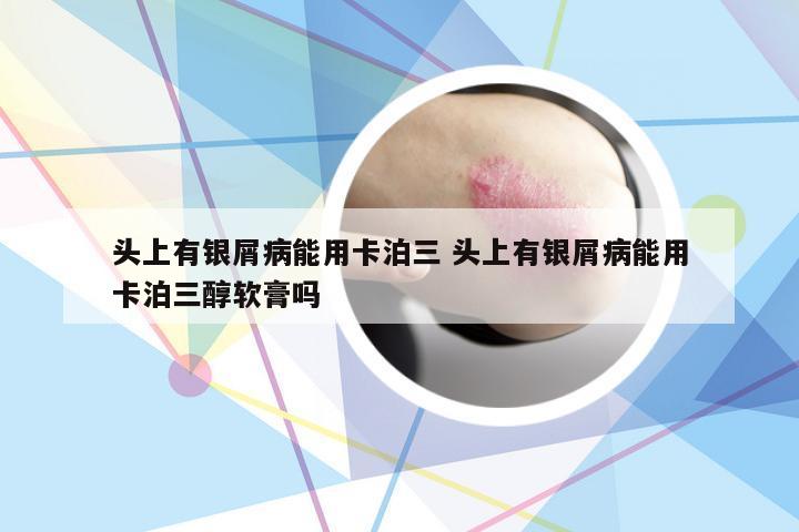 头上有银屑病能用卡泊三 头上有银屑病能用卡泊三醇软膏吗