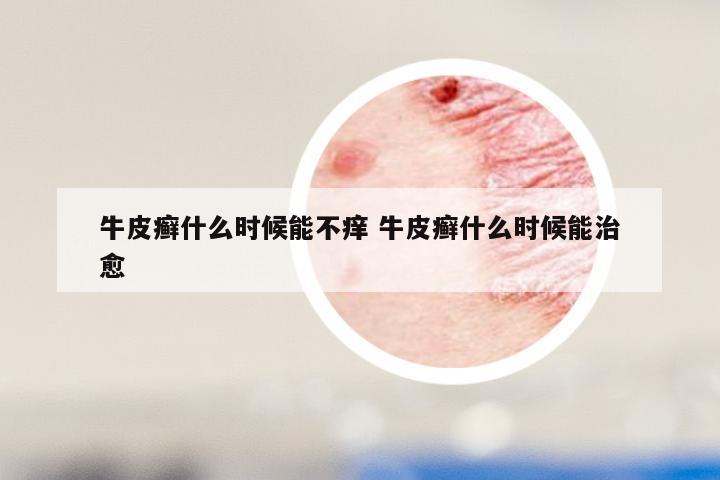 牛皮癣什么时候能不痒 牛皮癣什么时候能治愈