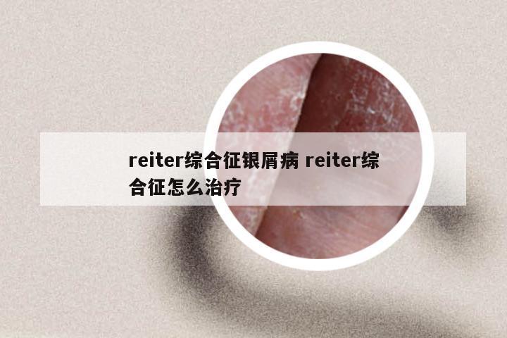 reiter综合征银屑病 reiter综合征怎么治疗