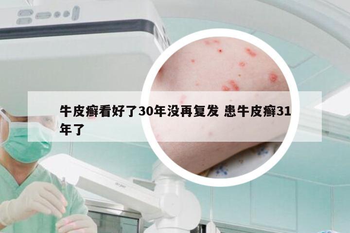 牛皮癣看好了30年没再复发 患牛皮癣31年了