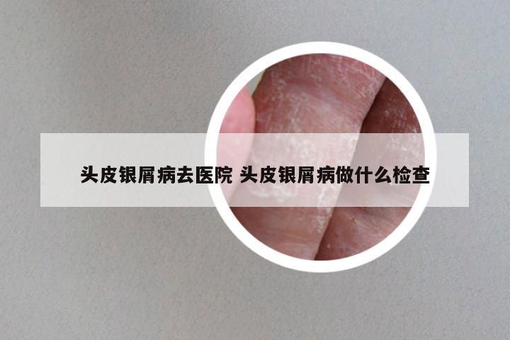 头皮银屑病去医院 头皮银屑病做什么检查