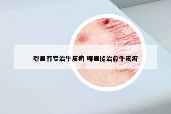 哪里有专治牛皮癣 哪里能治愈牛皮癣