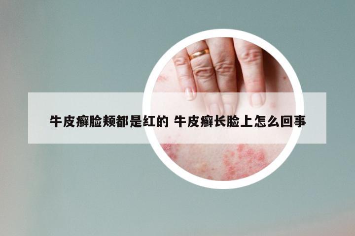 牛皮癣脸颊都是红的 牛皮癣长脸上怎么回事
