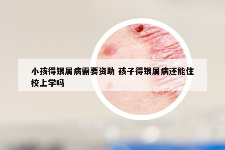 小孩得银屑病需要资助 孩子得银屑病还能住校上学吗