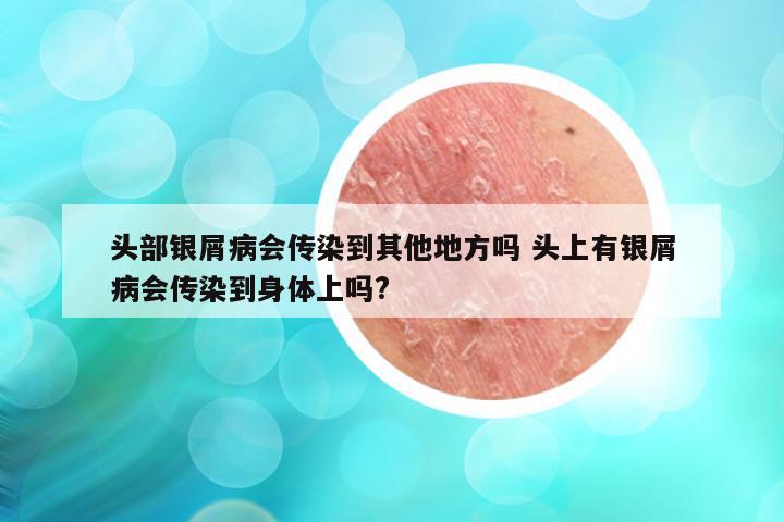 头部银屑病会传染到其他地方吗 头上有银屑病会传染到身体上吗?