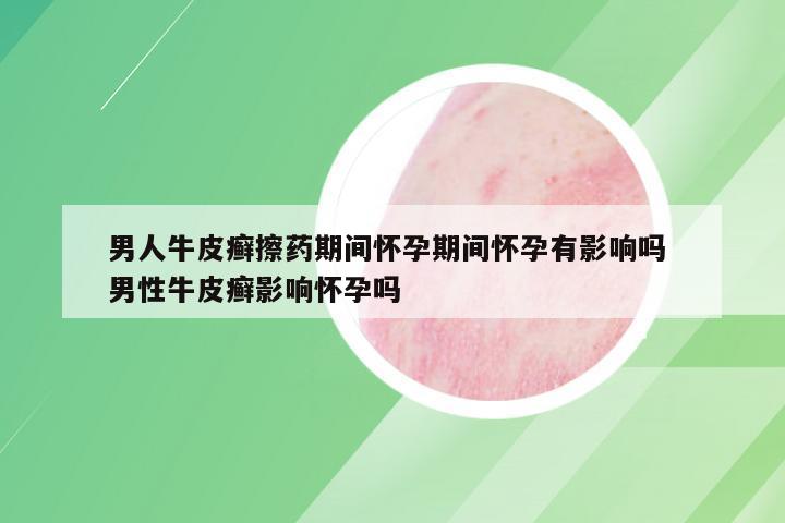 男人牛皮癣擦药期间怀孕期间怀孕有影响吗 男性牛皮癣影响怀孕吗