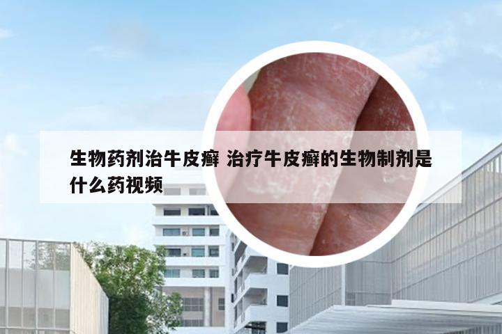 生物药剂治牛皮癣 治疗牛皮癣的生物制剂是什么药视频