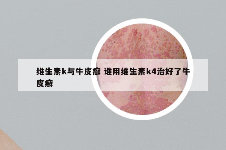 维生素k与牛皮癣 谁用维生素k4治好了牛皮癣