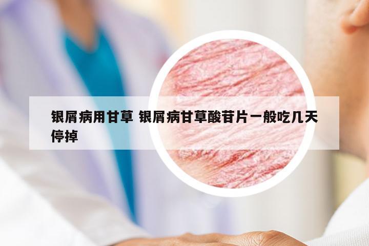 银屑病用甘草 银屑病甘草酸苷片一般吃几天停掉