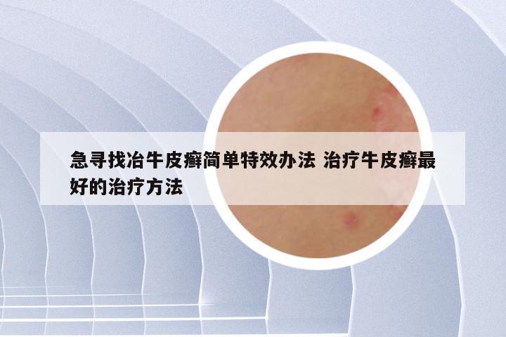 急寻找冶牛皮癣简单特效办法 治疗牛皮癣最好的治疗方法