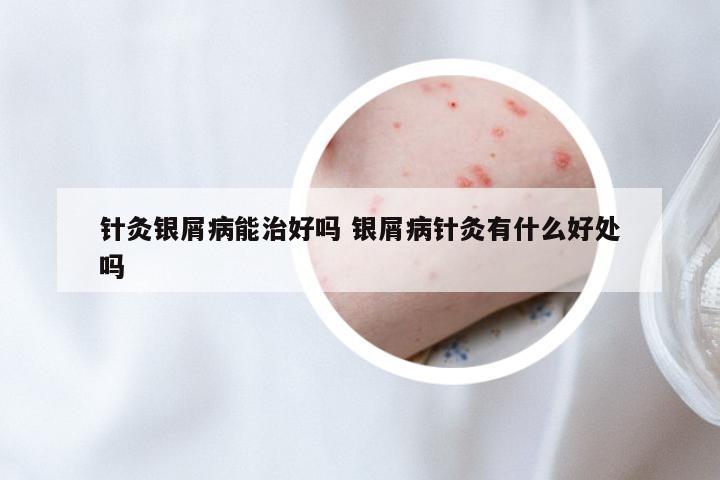 针灸银屑病能治好吗 银屑病针灸有什么好处吗