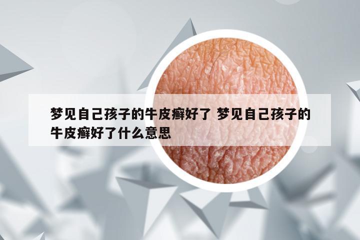 梦见自己孩子的牛皮癣好了 梦见自己孩子的牛皮癣好了什么意思