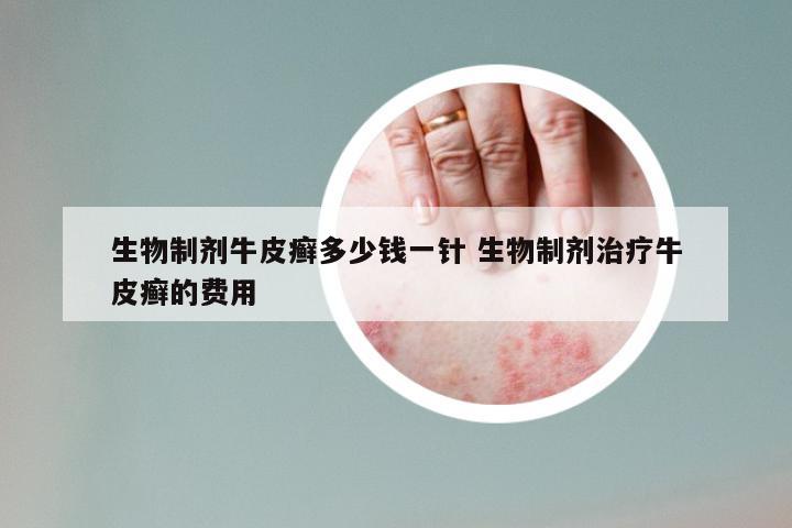 生物制剂牛皮癣多少钱一针 生物制剂治疗牛皮癣的费用