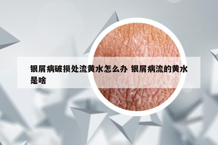 银屑病破损处流黄水怎么办 银屑病流的黄水是啥