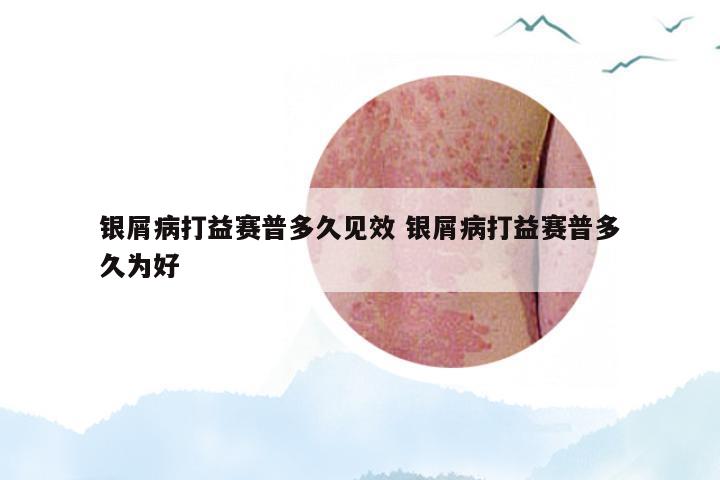 银屑病打益赛普多久见效 银屑病打益赛普多久为好