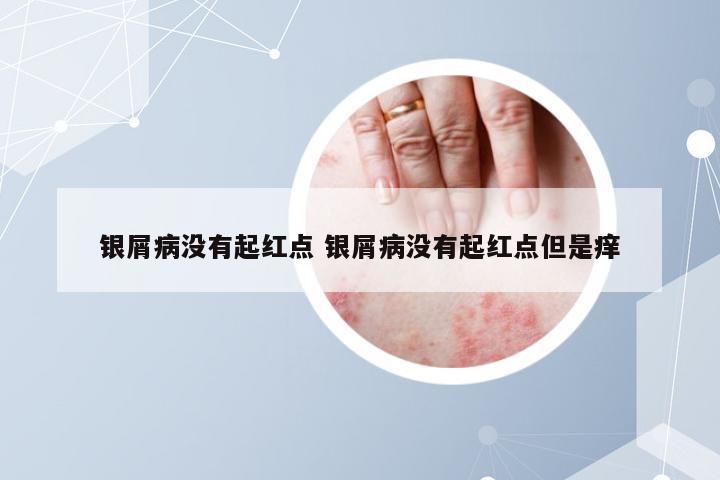 银屑病没有起红点 银屑病没有起红点但是痒
