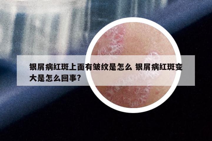 银屑病红斑上面有皱纹是怎么 银屑病红斑变大是怎么回事?