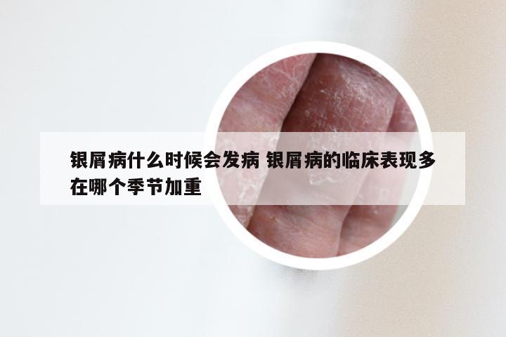 银屑病什么时候会发病 银屑病的临床表现多在哪个季节加重