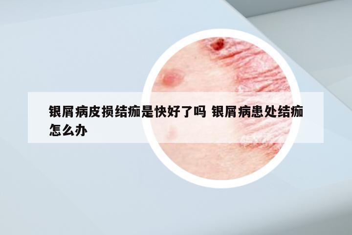 银屑病皮损结痂是快好了吗 银屑病患处结痂怎么办