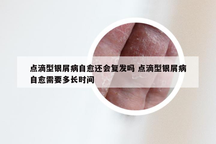 点滴型银屑病自愈还会复发吗 点滴型银屑病自愈需要多长时间