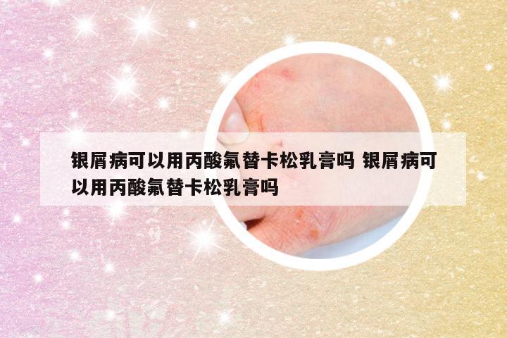 银屑病可以用丙酸氟替卡松乳膏吗 银屑病可以用丙酸氟替卡松乳膏吗