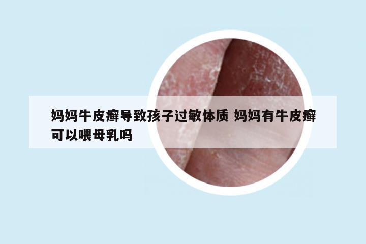 妈妈牛皮癣导致孩子过敏体质 妈妈有牛皮癣可以喂母乳吗