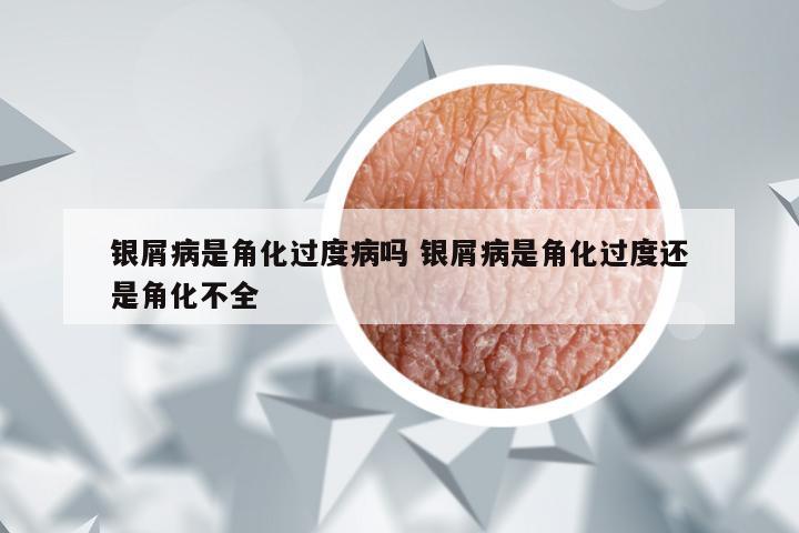 银屑病是角化过度病吗 银屑病是角化过度还是角化不全