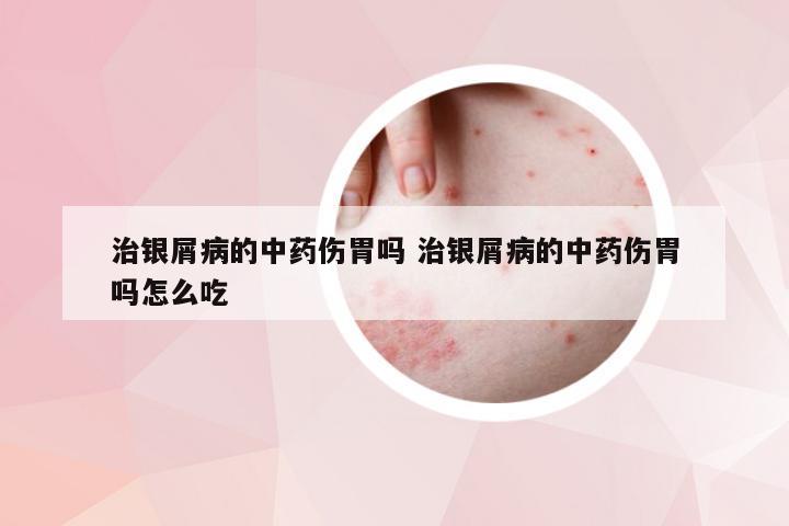 治银屑病的中药伤胃吗 治银屑病的中药伤胃吗怎么吃