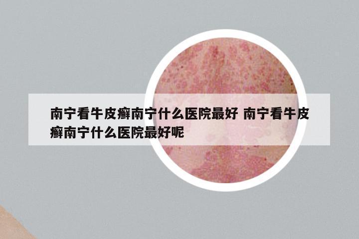 南宁看牛皮癣南宁什么医院最好 南宁看牛皮癣南宁什么医院最好呢