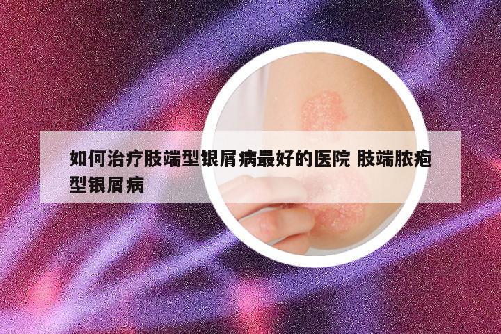 如何治疗肢端型银屑病最好的医院 肢端脓疱型银屑病