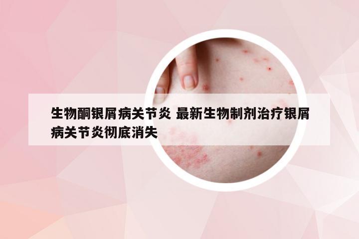 生物酮银屑病关节炎 最新生物制剂治疗银屑病关节炎彻底消失
