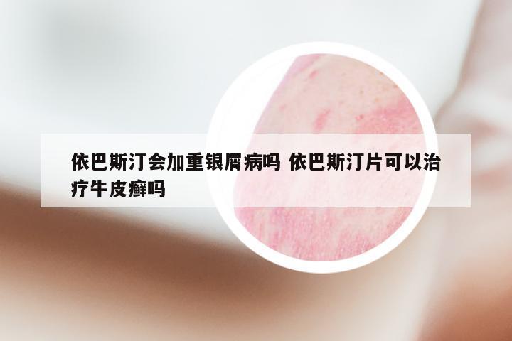 依巴斯汀会加重银屑病吗 依巴斯汀片可以治疗牛皮癣吗