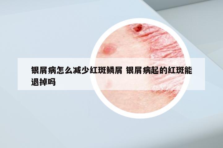 银屑病怎么减少红斑鳞屑 银屑病起的红斑能退掉吗