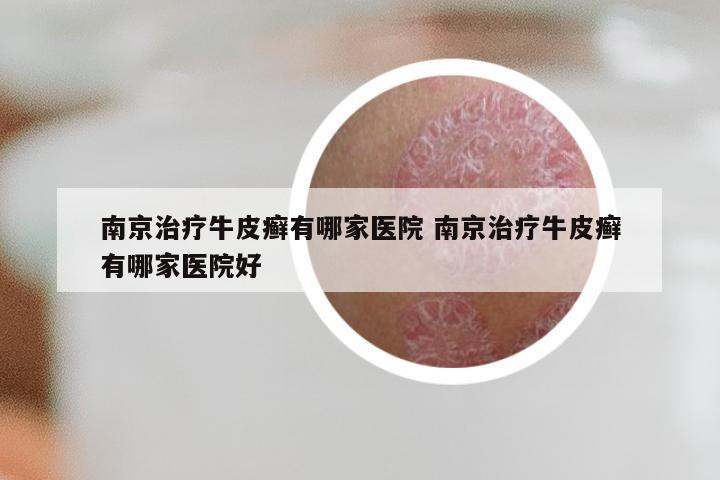 南京治疗牛皮癣有哪家医院 南京治疗牛皮癣有哪家医院好