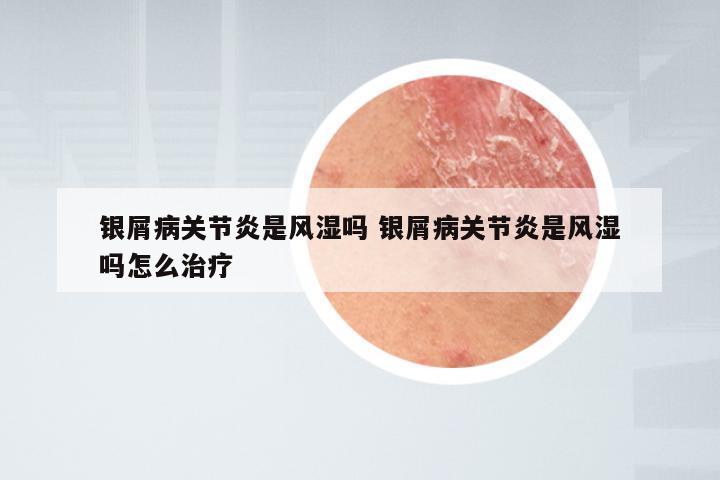 银屑病关节炎是风湿吗 银屑病关节炎是风湿吗怎么治疗