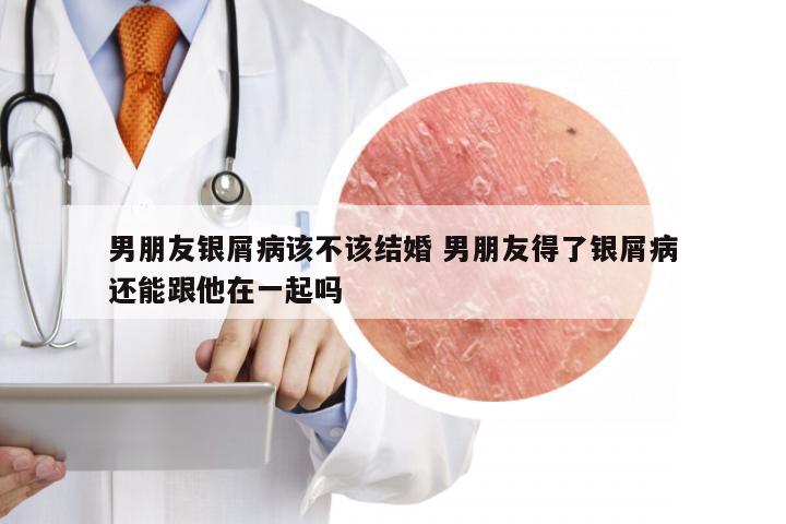 男朋友银屑病该不该结婚 男朋友得了银屑病还能跟他在一起吗