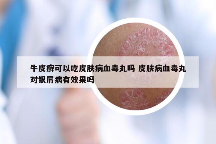 牛皮癣可以吃皮肤病血毒丸吗 皮肤病血毒丸对银屑病有效果吗