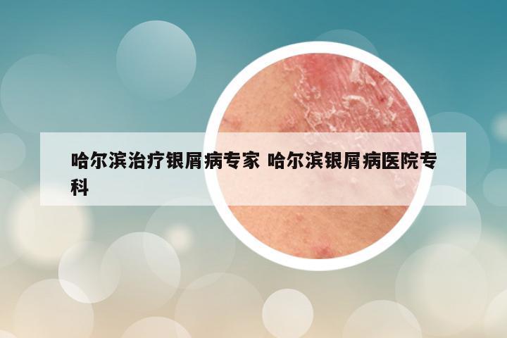 哈尔滨治疗银屑病专家 哈尔滨银屑病医院专科