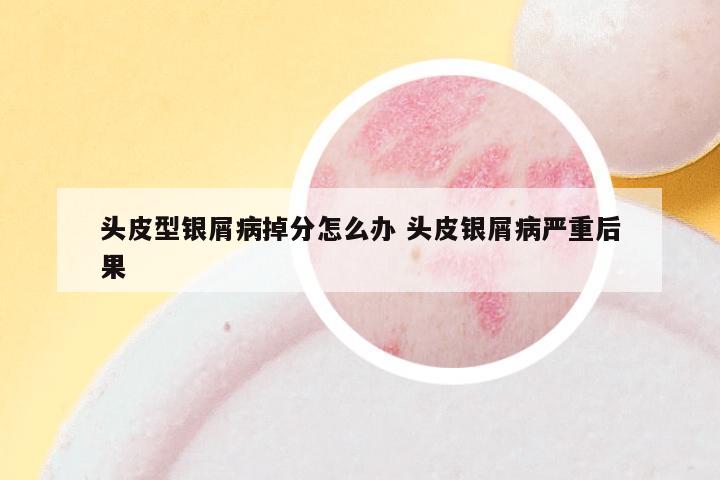 头皮型银屑病掉分怎么办 头皮银屑病严重后果