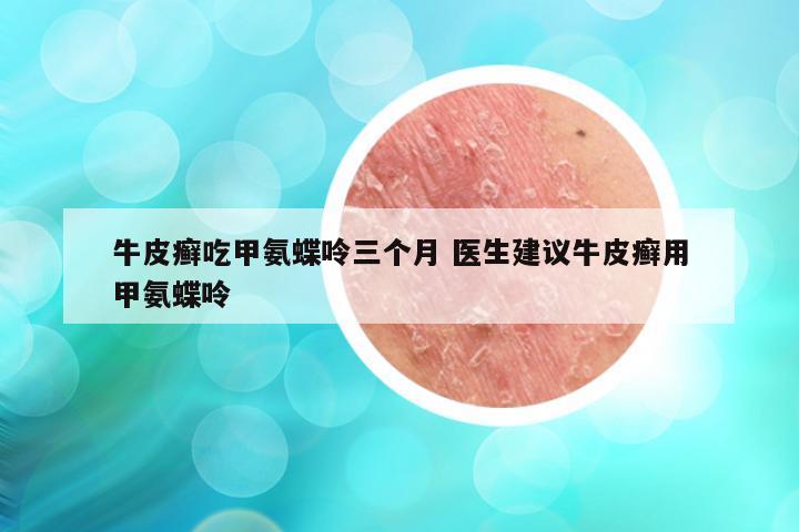 牛皮癣吃甲氨蝶呤三个月 医生建议牛皮癣用甲氨蝶呤