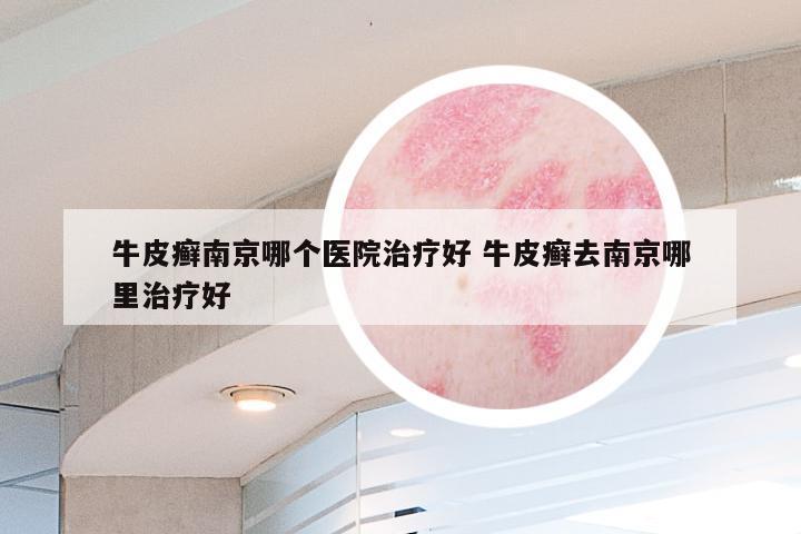 牛皮癣南京哪个医院治疗好 牛皮癣去南京哪里治疗好