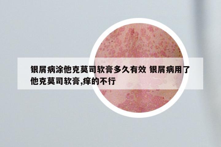 银屑病涂他克莫司软膏多久有效 银屑病用了他克莫司软膏,痒的不行