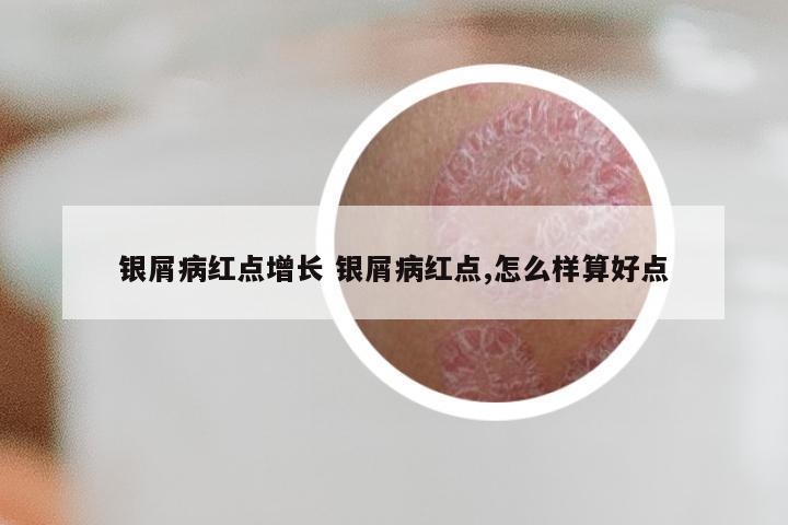 银屑病红点增长 银屑病红点,怎么样算好点