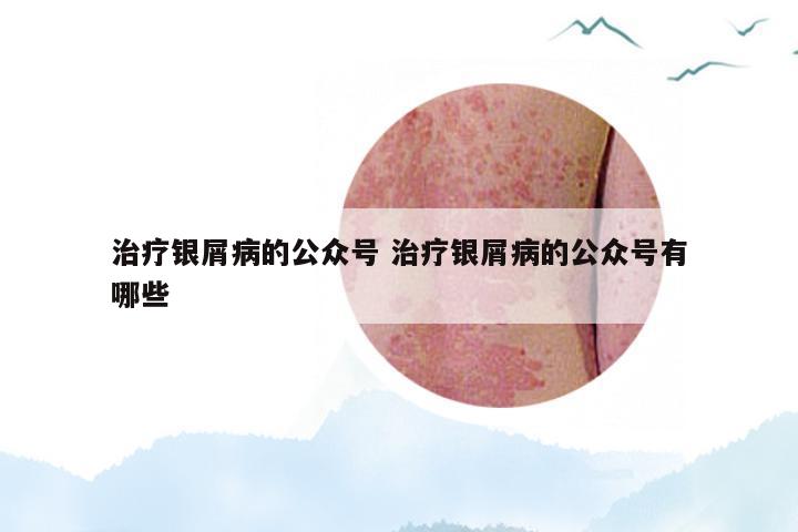 治疗银屑病的公众号 治疗银屑病的公众号有哪些