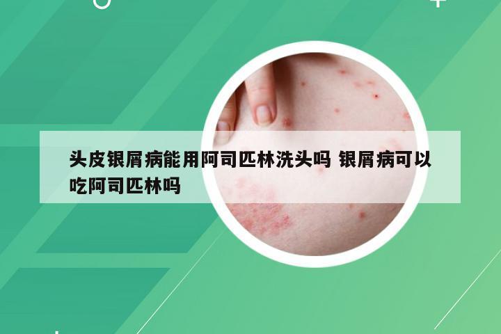 头皮银屑病能用阿司匹林洗头吗 银屑病可以吃阿司匹林吗