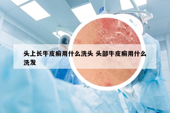 头上长牛皮癣用什么洗头 头部牛皮癣用什么洗发