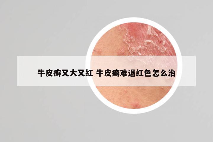 牛皮癣又大又红 牛皮癣难退红色怎么治